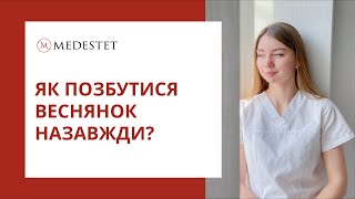 Як позбутись веснянок назавжди? Чи це реально?