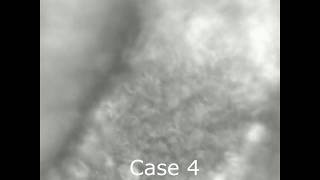 Asvide: Case 4 cilia motility assessment