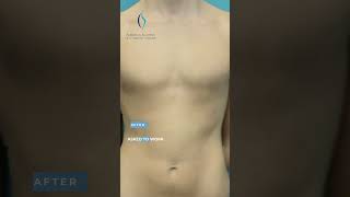 Dr. Dastoury: Gynecomastia Treatment #gynecomastiaresult #gynecomastiasurgery #medicaleducation