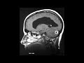 neuroradiology teaching case 81