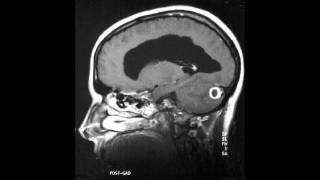 Neuroradiology Teaching Case 81