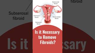 जाने क्या बच्चेदानी की गांठ (Fibroids) को निकलवाना जरूरी होता है?