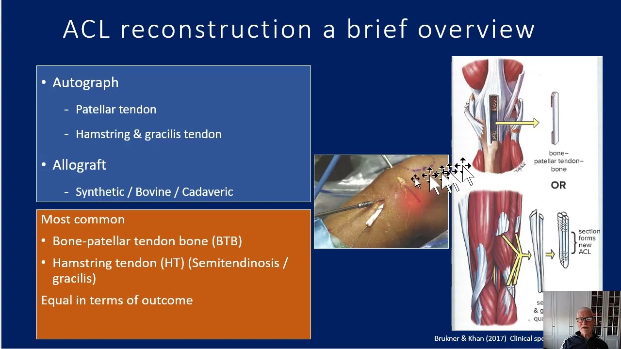 ACL Rehabilitation Guidelines - A Guide For Therapists & Patients - YouTube