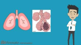 Pulmonary Fibrosis and Systemic Sclerosis