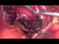 Total Laparoscopic Hysterectomy and Uterosacral Ligament Suspension