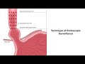 barrett s esophagus biopsies graphic illustration