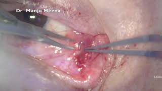 Medial Ectropion Surgery