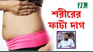 ফাটা দাগ তলপেট ছাড়াও শরীরের আর কোন অংশে দেখা যায়? Health Show | স্বাস্থ্য প্রতিদিন |