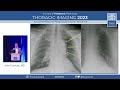 radiographic appearances of lung cancer