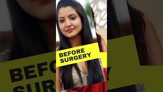 #AnushkaSharma Before And After #PlasticSurgery 😱Can you guess which surgery she got done? #shorts