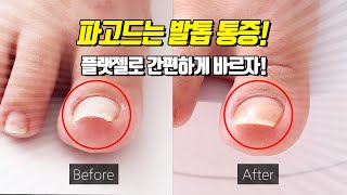 파고드는 발톱통증! 플랫젤로 간편하게 바르자! Easily treat ingrown toenails using flatgel. Lupine Flatgel