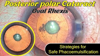 Posterior polar Cataract, Oval Rhexis, Strategies for Safe Phacoemulsification - Dr Deepak Megur