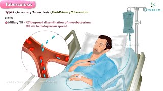 Tuberculosis🫁🦠 : Microbiology , Clinical features , Diagnosis , Treatment