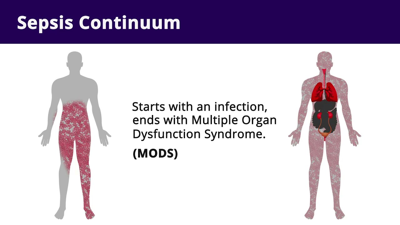 Septic Shock (Sepsis) | Pathophysiology And Nursing Interventions - YouTube