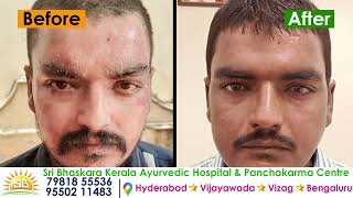 Psoriasis Treatment in Hyderabad//Sri Bhaskara Kerala Ayurveda hospital call 7981855536