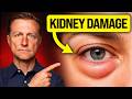 Your Eyes Reveal Kidney Damage Years Before Symptoms