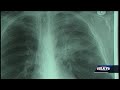 UofL Health oncologist says lung cancer in non-smokers becoming more common