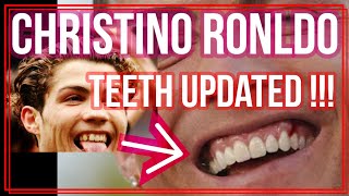 Christiano Ronaldo teeth newly updated!! before and after 🤓 then & now cosmetic transformation