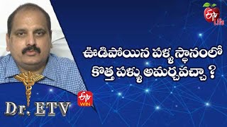 ఊడిపోయిన పళ్ళ స్థానంలో కొత్త పళ్ళు అమర్చవచ్చా ? | డాక్టర్ ఈటీవీ  | 6th ఏప్రిల్ 2022| ఈటీవీ  లైఫ్