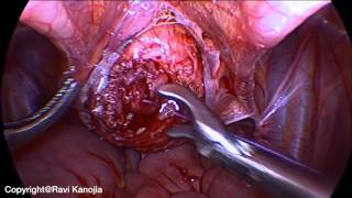 Laparoscopic Cystolithotomy