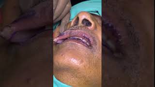 Lip Reduction Live Procedure On 71 Year Old #shorts #shortsfeed