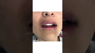 Gummy smile treatment laser gum treatment laser gum contouring gum lift before and after Dr. Yazdan