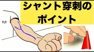 シャント穿刺のポイント