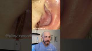 Derm reacts to juicy pimple pop! #dermreacts #doctorreacts #pimplepop