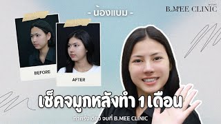 รีวิวน้องแบมหลังทำจมูก 1 เดือน by หมอหมี