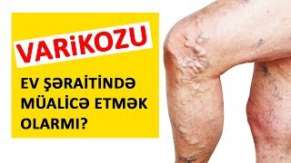 Varikozu ev şəraitində müalicə etmək olarmı? - Dr. Ceyhun Hüseynov