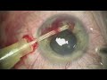 Transcameral iris biopsy using angiocatheter by Scott Oliver, MD