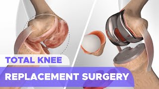 Total Knee Replacement Surgery (Knee Arthroplasty)
