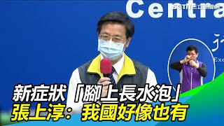 「腳上長水泡」武漢肺炎新症狀！張上淳坦承：我國好像也有｜三立新聞網SETN.com