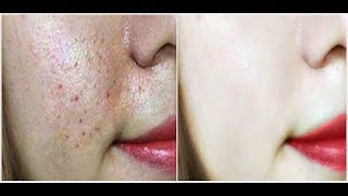 Overnight Depigmenting Serum to remove pigmentation, dark spots, melasma, facial scars