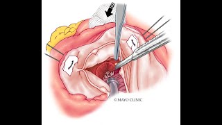 Hypertrophic cardiomyopathy guideline update: Mayo Clinic's perspective