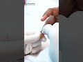 ✨വേദന ഇല്ലാതെ അരിമ്പാറ കരിക്കാം ✨wart removal with electrocautery @dermavue