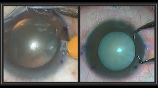 Is there a role for manual Limbal relaxing incisions (LRI) in today's surgical practice