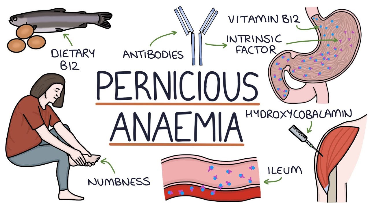 Understanding Pernicious Anaemia (B12 Deficiency) - YouTube