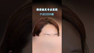 韓國美女FUE2200根頭髮植髮效果 #韓國植髮醫院推薦 #hairtransplantsurgery #永長植髮 #hairtransformation #fue植髮 #女性髮際線植髮#fut植髮