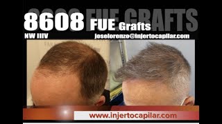 8608FUE Grafts. Repair.Thin/White/short donor.Shaved. 5 surgeries/8years.Injertocapilar.com1494/2015