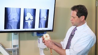 Partial Knee Replacement - A Total Solution for a Partial Problem