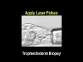 zilos tk laser trophectoderm biopsy