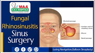 Fungal Rhinosinusitis - Sinus Surgery (using Navigation,Balloon Sinoplasty)