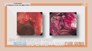 인스턴트 음식, 배달 음식 섭취 때문? 대장암이 생기는 원인 | 100세 프로젝트 44 회