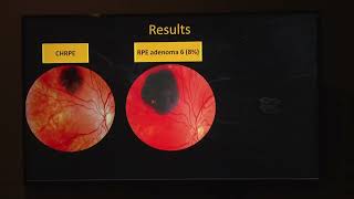 AIOCMT3 2024 FP Ocular – II + Finals FP734 Dr Ruju Unadkat Many faces of congenital hypertrophy