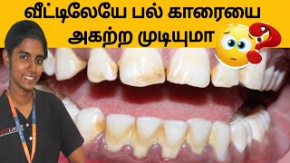 பற்காரைகளை எளிமையாக நீக்க ஒரே  வழி! One simple method to remove teeth tartar safely fully in tamil