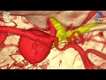 neurosurgical approach for a giant supraclinoid aneurysm