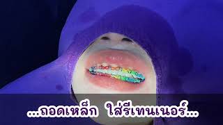 ถอดเหล็กจัดฟัน และใส่รีเทนเนอร์ #จัดฟัน #orthodontics