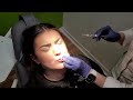 russian lip technique lip filler