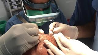 FUE Scarless Hair Transplantation